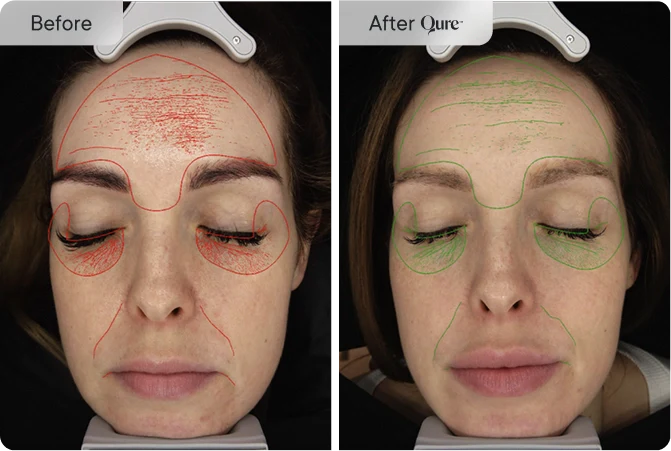 Fine Lines & Wrinkles