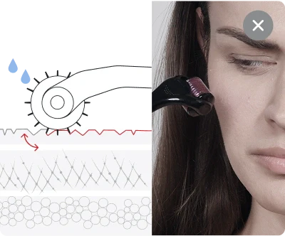 Other At-Home Needling Devices